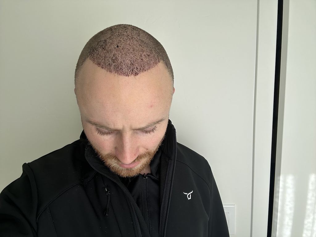 Smile Hair Clinic Hair Transplant Turkey Istanbul — Istanbul, Turkey