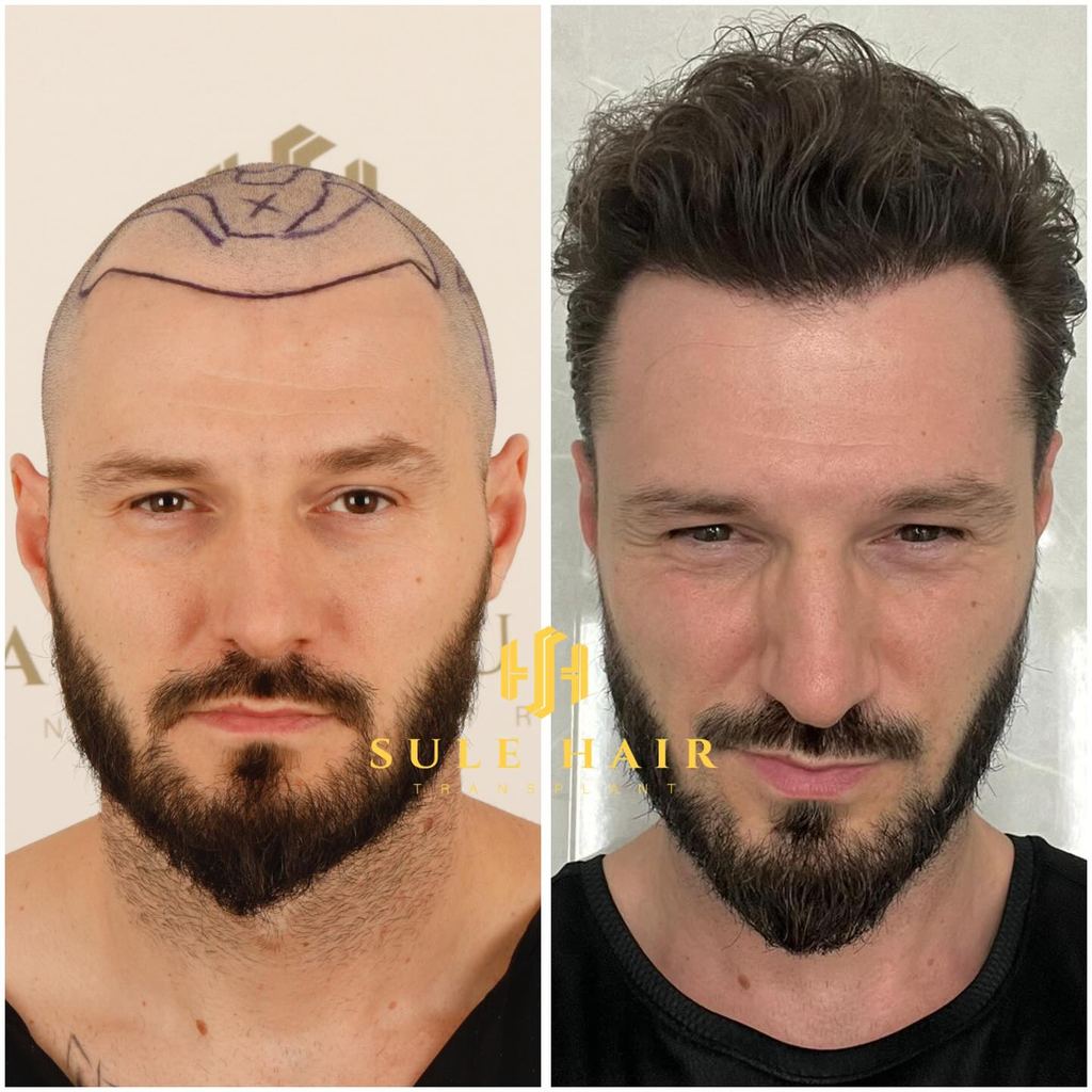 Sule Hair Transplant: Hair Transplant Turkey — Istanbul, Turkey