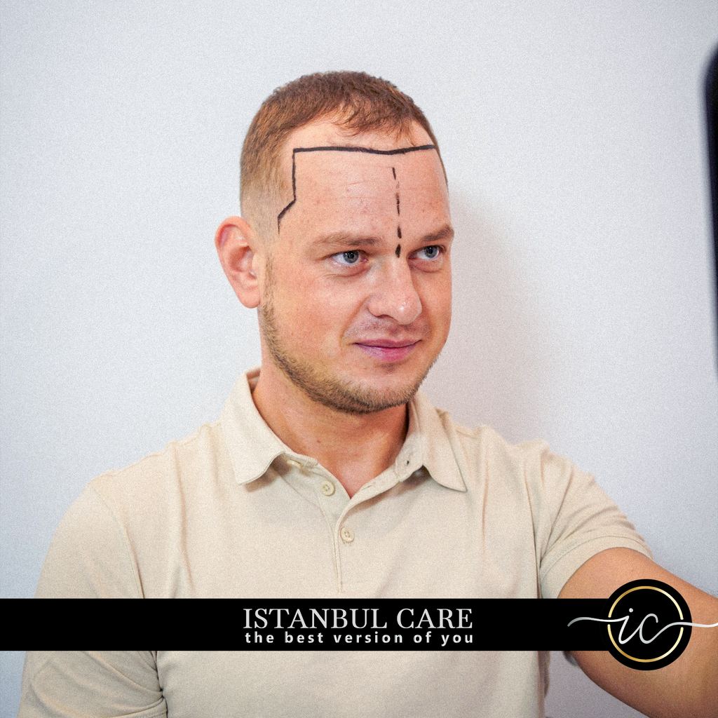 Istanbul Care | Hair Transplant Turkey — Istanbul, Turkey