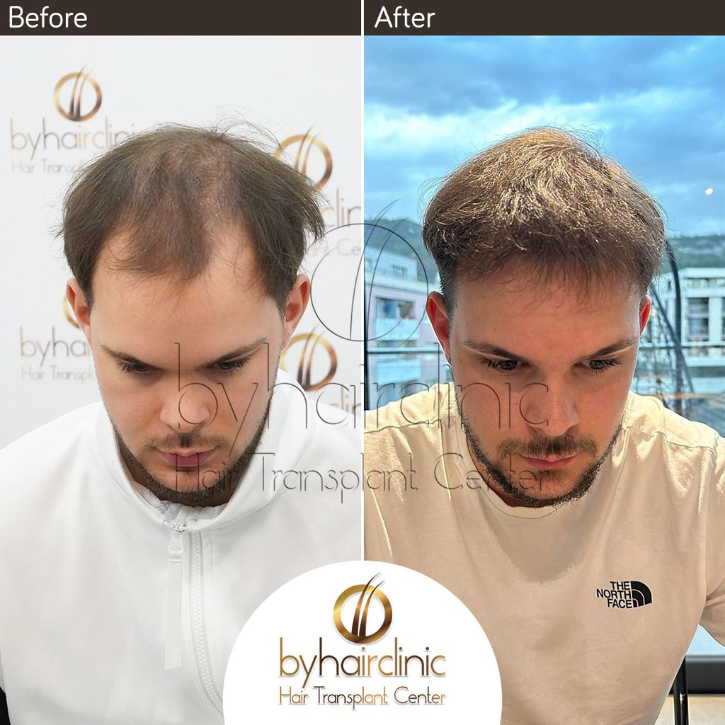 byhairclinic | Hair Transplant Center — Istanbul, Turkey