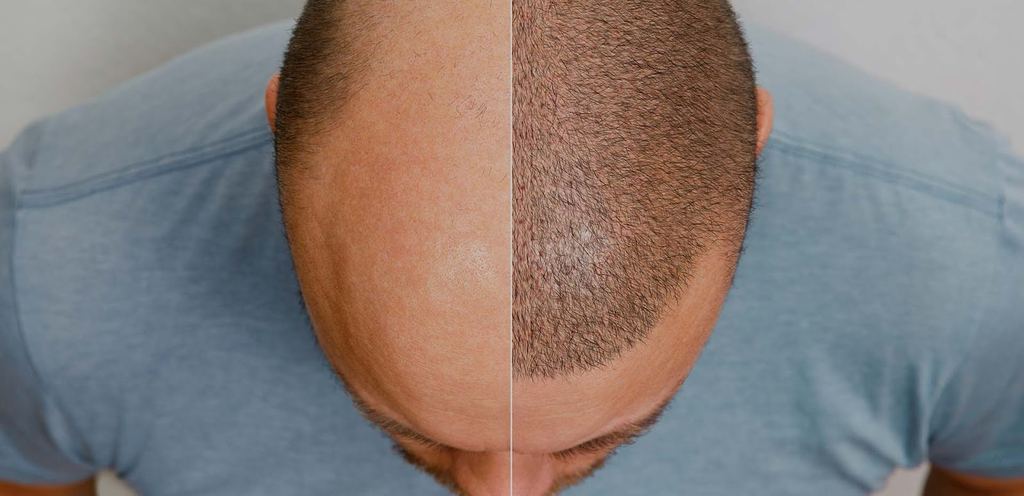 Elos Saç Ekim Merkezi - Ankara'nın En Büyük Saç Ekimi Kliniği | Safir FUE & DHI Hair Transplant — Ankara, Turkey